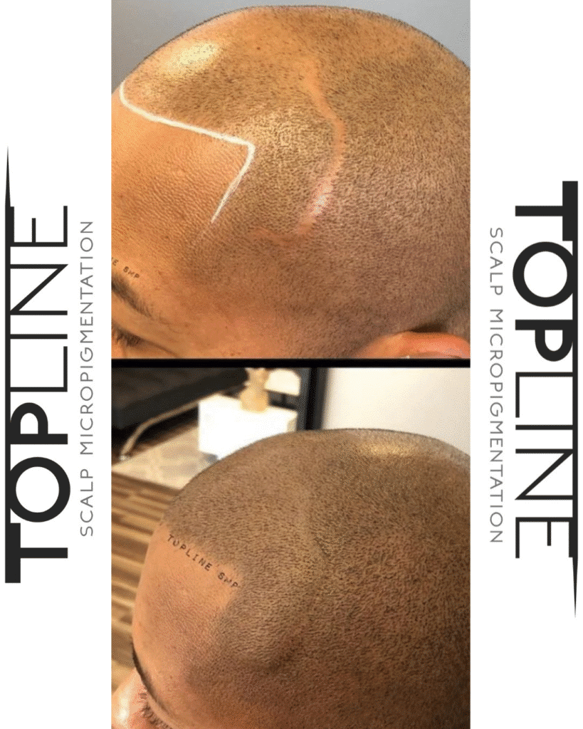 SMP treatment before and after Cherry Hill NJ